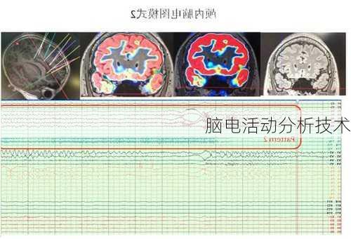 脑电活动分析技术