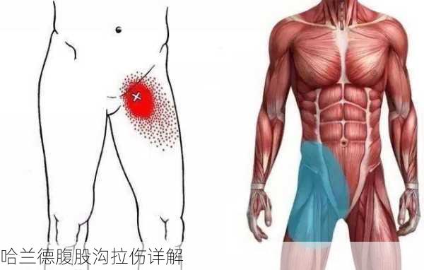 哈兰德腹股沟拉伤详解