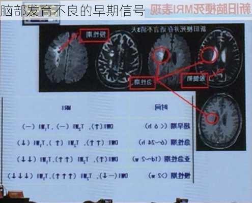 脑部发育不良的早期信号