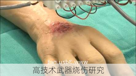 高技术武器烧伤研究