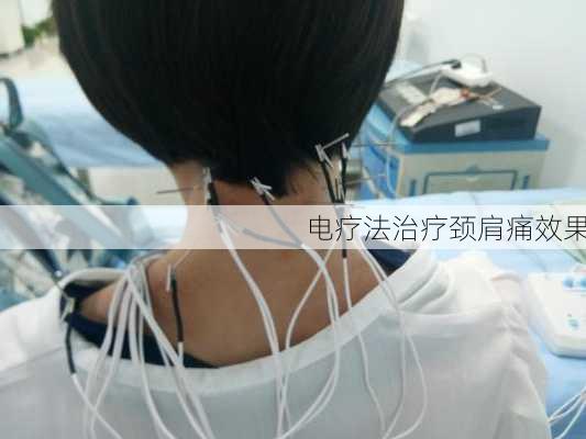 电疗法治疗颈肩痛效果