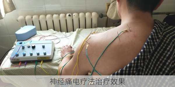 神经痛电疗法治疗效果