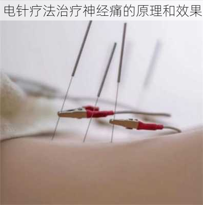 电针疗法治疗神经痛的原理和效果