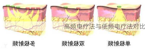 高频电疗法与低频电疗法对比