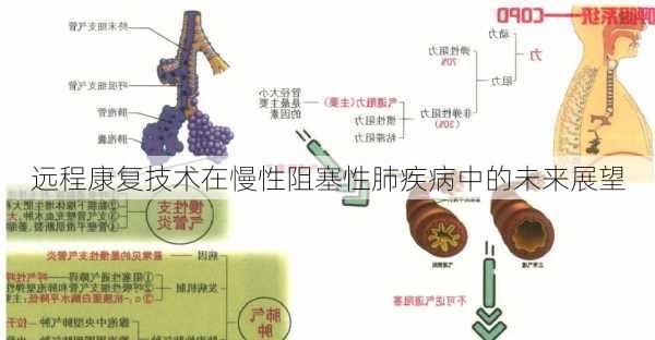 远程康复技术在慢性阻塞性肺疾病中的未来展望