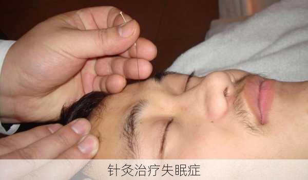 针灸治疗失眠症