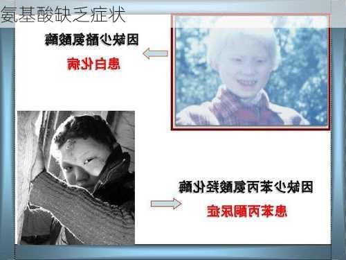 氨基酸缺乏症状