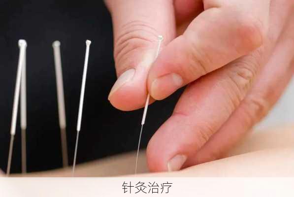 针灸治疗