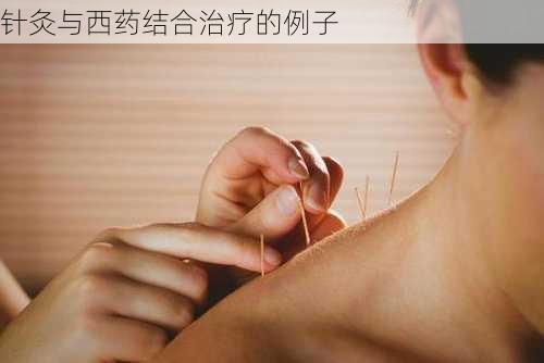 针灸与西药结合治疗的例子