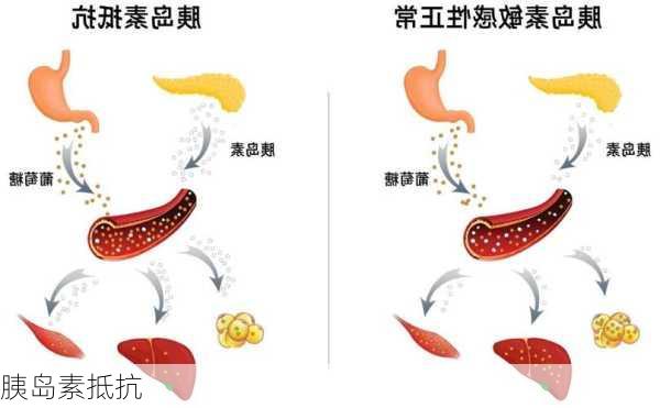 胰岛素抵抗