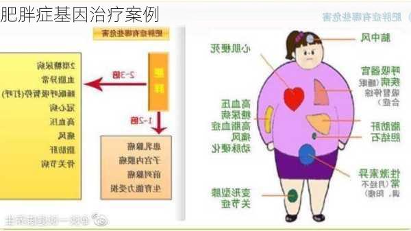 肥胖症基因治疗案例