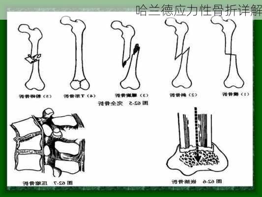 哈兰德应力性骨折详解