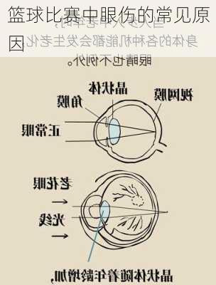 篮球比赛中眼伤的常见原因