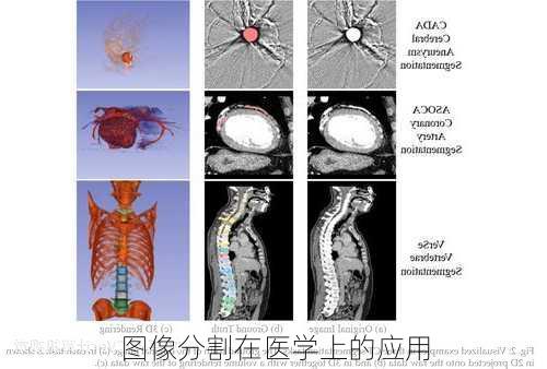 图像分割在医学上的应用