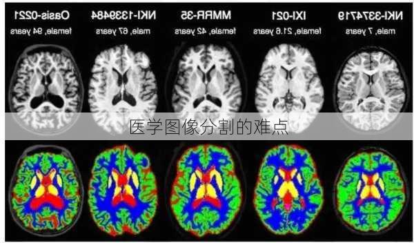 医学图像分割的难点