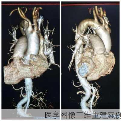 医学图像三维重建案例