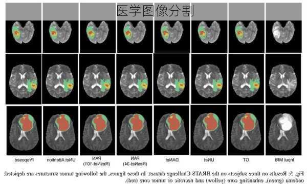 医学图像分割