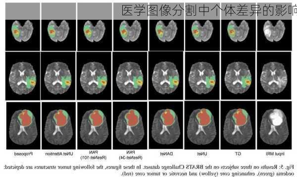 医学图像分割中个体差异的影响