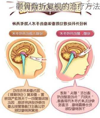 颧骨骨折复视的治疗方法