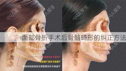 面部骨折手术后骨骼畸形的纠正方法