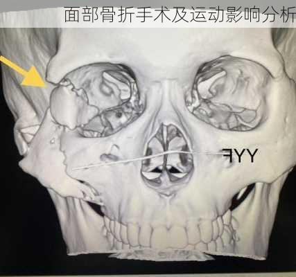 面部骨折手术及运动影响分析