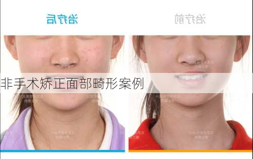非手术矫正面部畸形案例