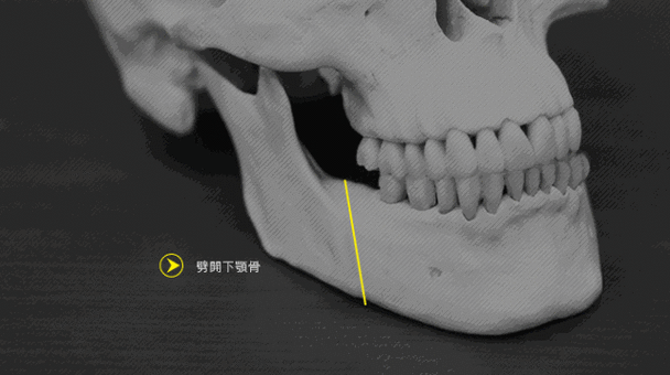面部骨折手术后骨骼畸形的矫正方法及手术效果评估