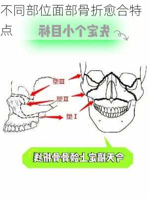 不同部位面部骨折愈合特点