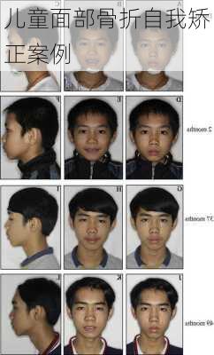 儿童面部骨折自我矫正案例
