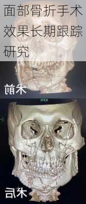 面部骨折手术效果长期跟踪研究