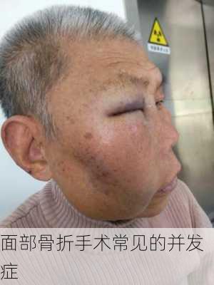 面部骨折手术常见的并发症
