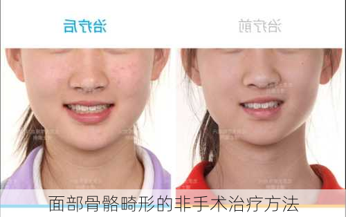 面部骨骼畸形的非手术治疗方法