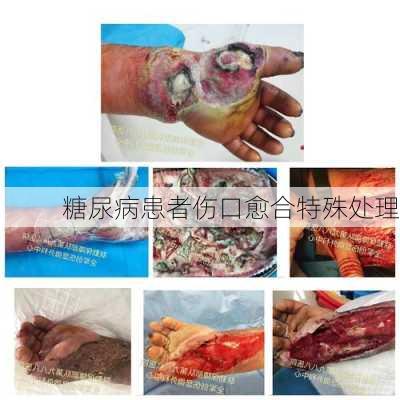 糖尿病患者伤口愈合特殊处理