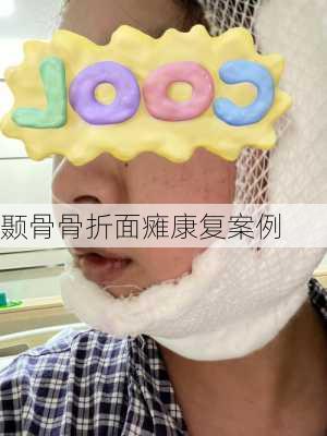 颞骨骨折面瘫康复案例
