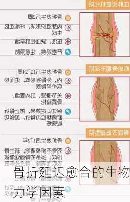 骨折延迟愈合的生物力学因素
