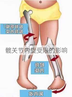 髋关节内旋受限的影响