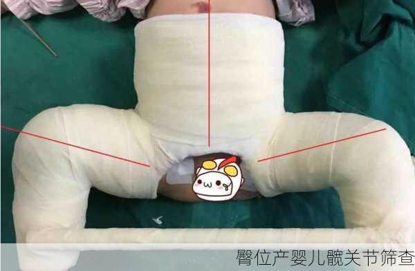 臀位产婴儿髋关节筛查