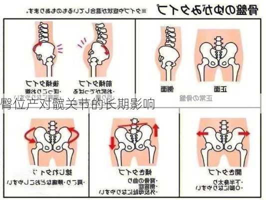 臀位产对髋关节的长期影响