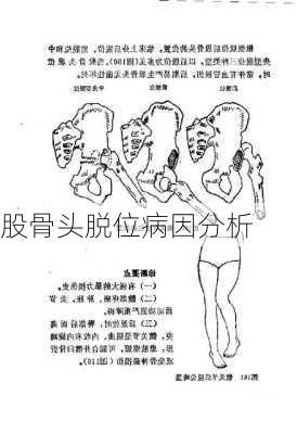 股骨头脱位病因分析