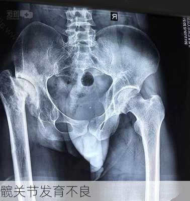 髋关节发育不良