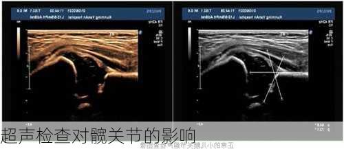 超声检查对髋关节的影响