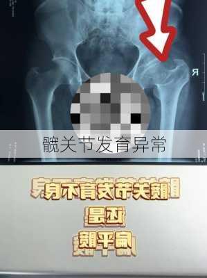 髋关节发育异常