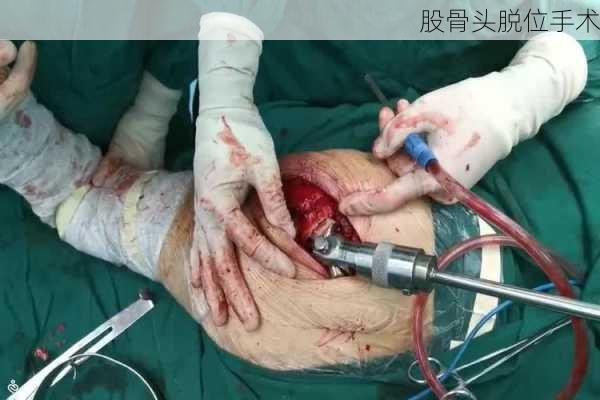股骨头脱位手术