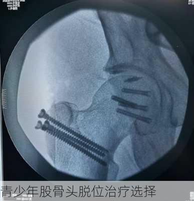 青少年股骨头脱位治疗选择