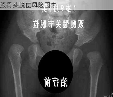 股骨头脱位风险因素
