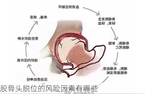 股骨头脱位的风险因素有哪些