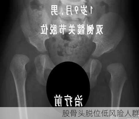 股骨头脱位低风险人群