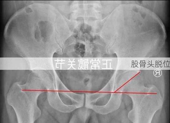 股骨头脱位