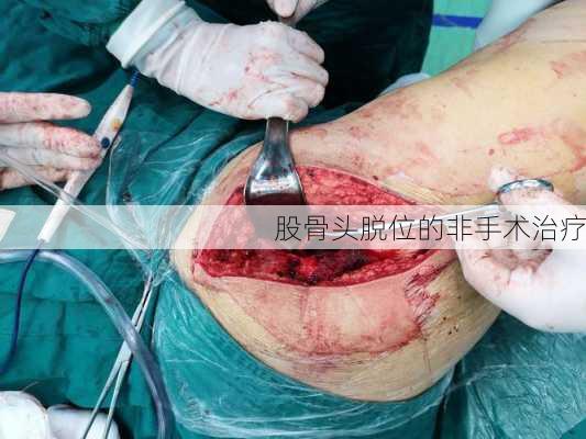股骨头脱位的非手术治疗